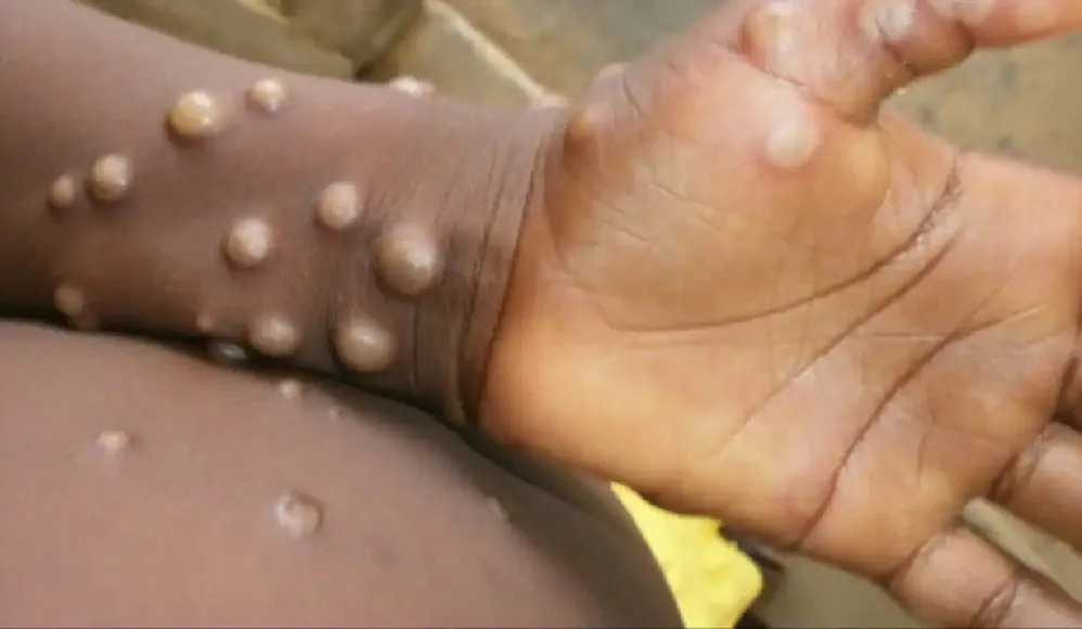 Monkeypox बन चुका है महामारी! वर्ल्ड हेल्थ नेटवर्क ने कर दी घोषणा, जाने इस वायरस के लक्षण
