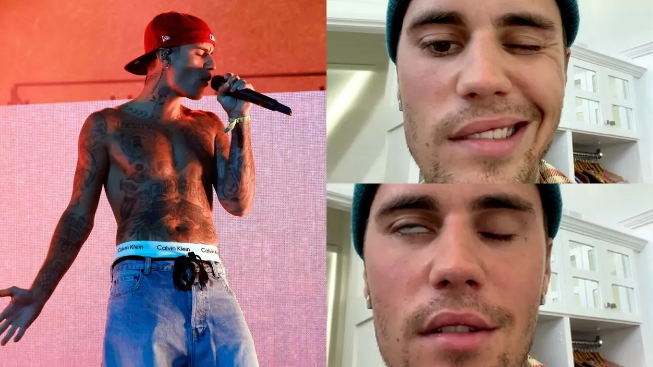 Justin Bieber हुए चेहरे पर लकवे के शिकार, रामसे हंट सिंड्रोम से हैं संक्रमित